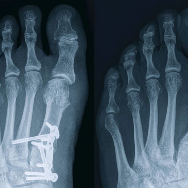 Hallux valgus und Lapidus Arthrodese