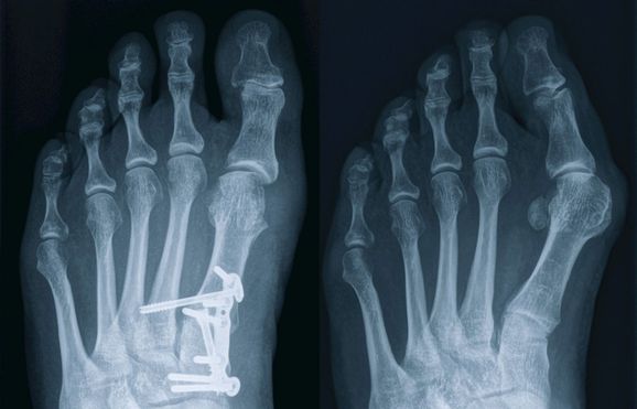 Hallux valgus und Lapidus Arthrodese