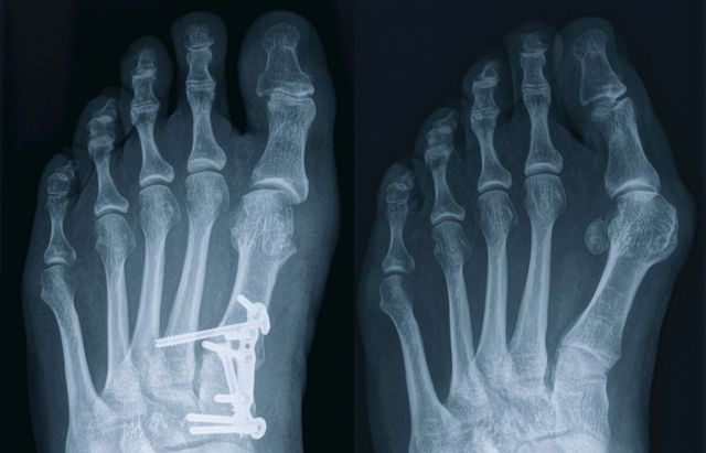 Hallux valgus und Lapidus Arthrodese